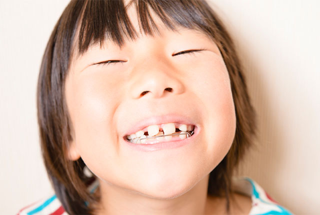 子どもの矯正治療
